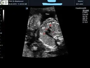 Fetal Echo - T&3VV