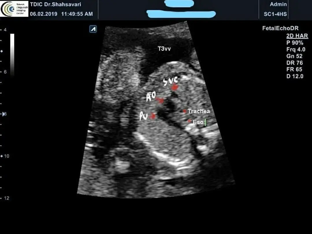 Fetal Echo - T&3VV