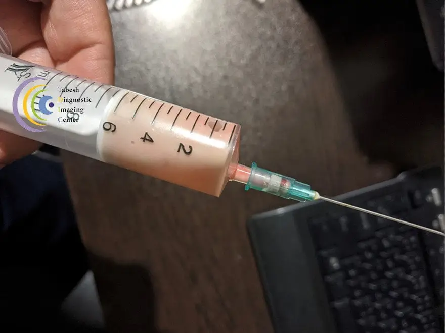 آسپیراسیون آبسه