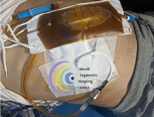 درناژ صفراوی